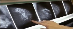 Radiology biopsies at Speare
